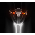 Cancer Ovarian